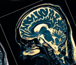 Nörologlar açıkladı: Bu 2 mesleği yapanların Alzheimer’a yakalanma riski çok düşük